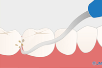 フェニックス歯科の歯石除去