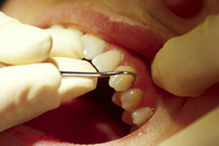 フェニックス歯科の歯石除去